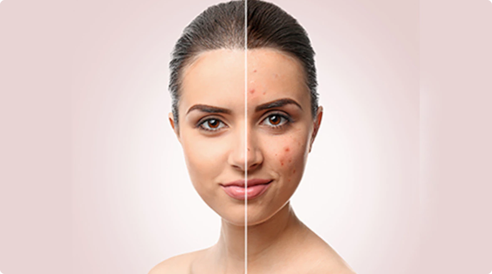 Acne Scar Treatment