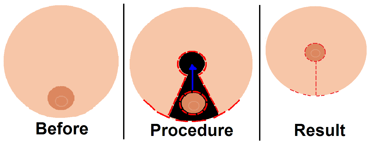 Breast Reduction