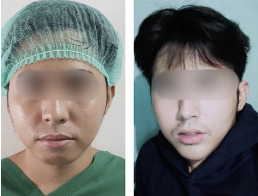 Chin Augmentation