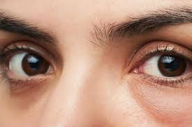 Eye Bag Correction