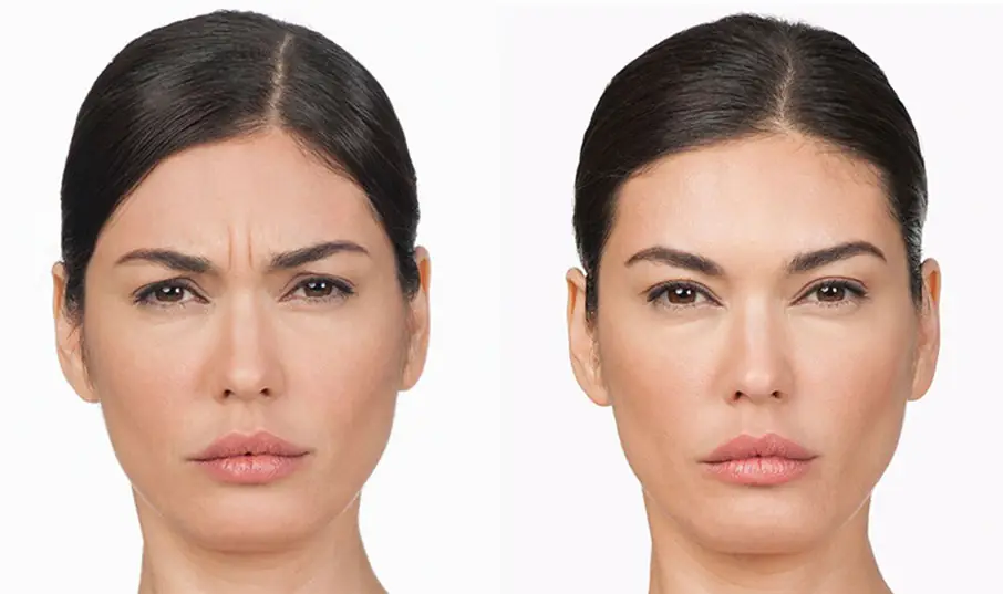 Eyebrow Lift