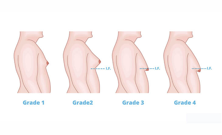 Grade IV Gynaecomastia