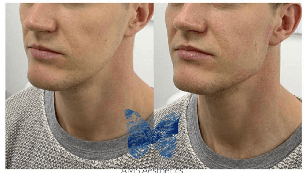 Jawline Contouring