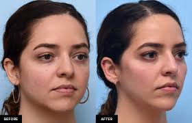 Jawline & Chin Filler