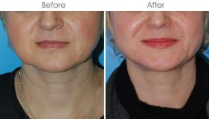 Jowl Lift