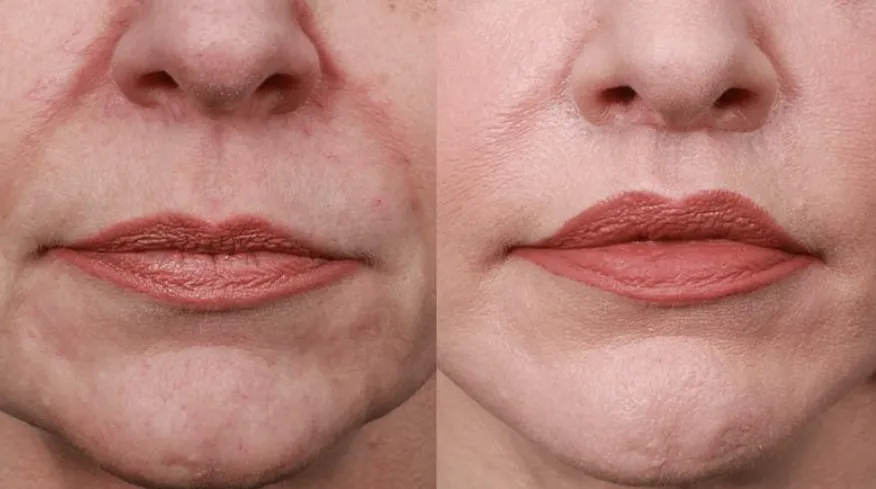 Lip Lift