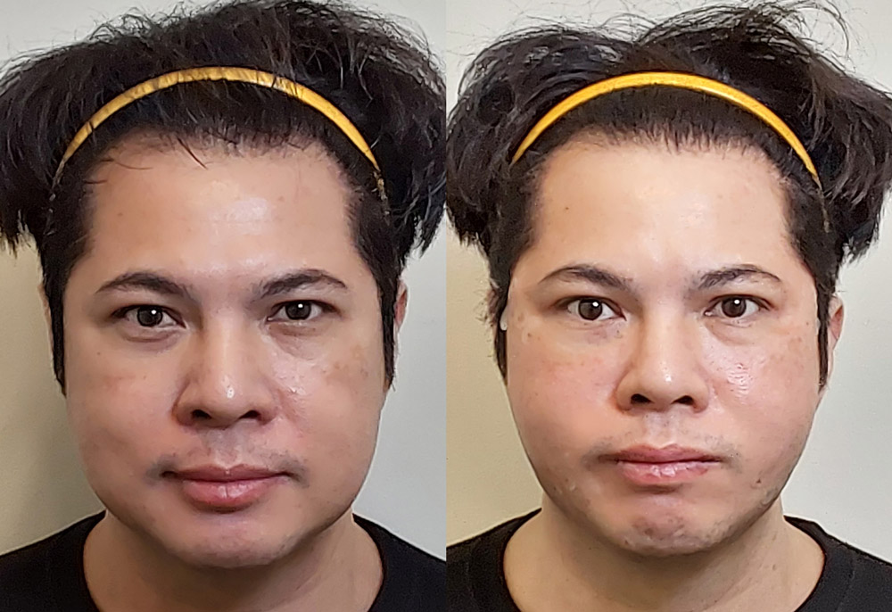 Midface Thread Lift