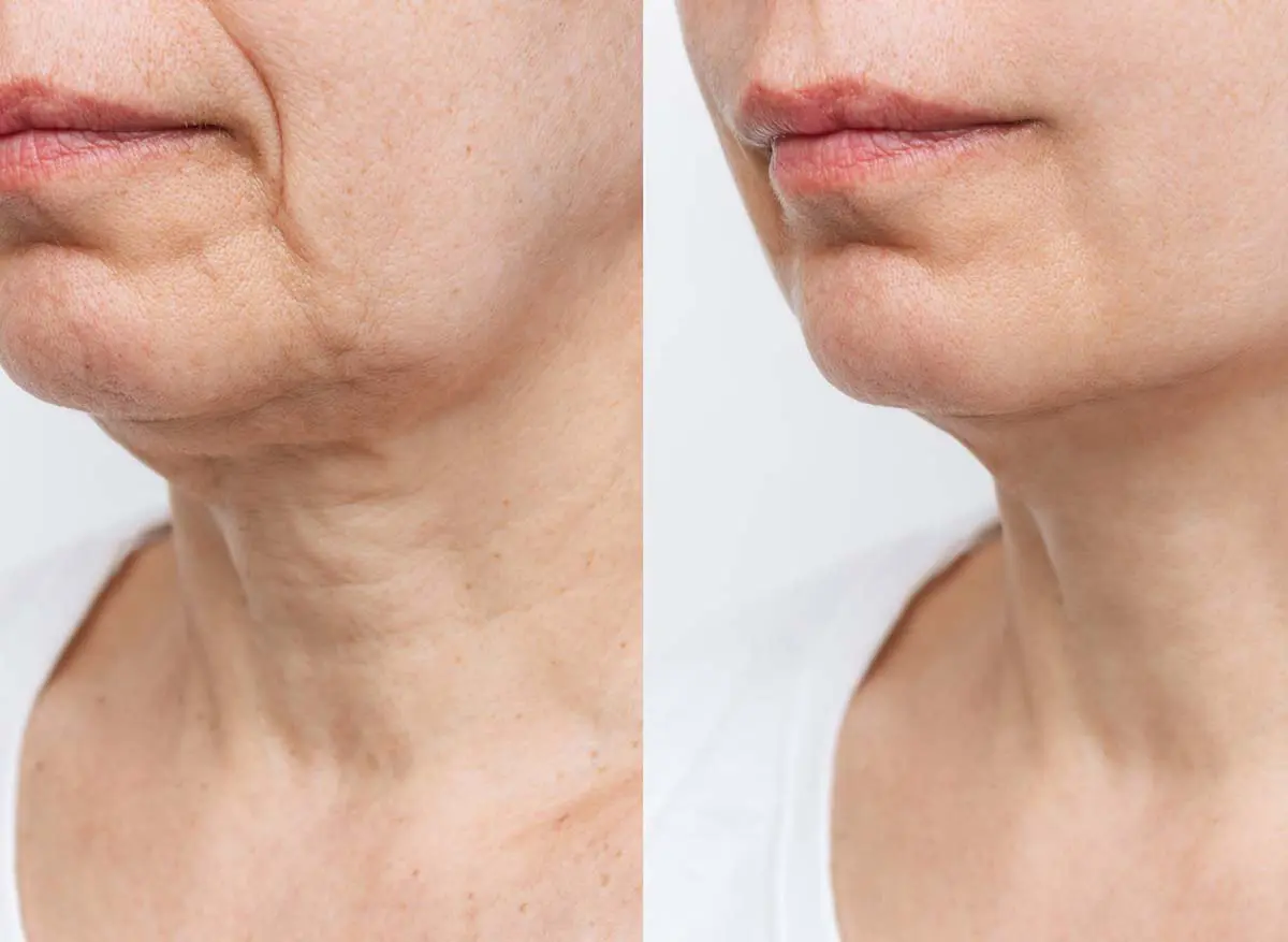 Neck Lift