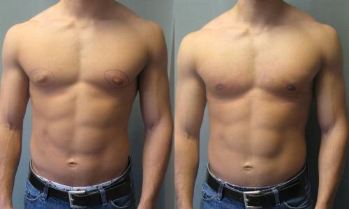 Puffy Nipple Correction