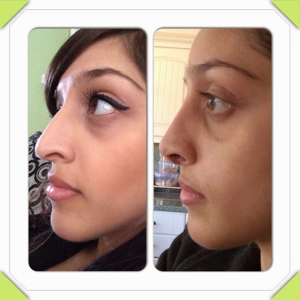 Septorhinoplasty