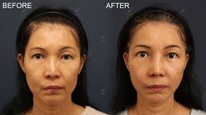 SMAS Facelift