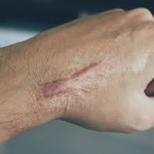Traumatic Scar Revision