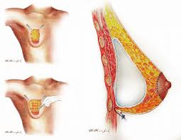 Tuberous Breast Correction