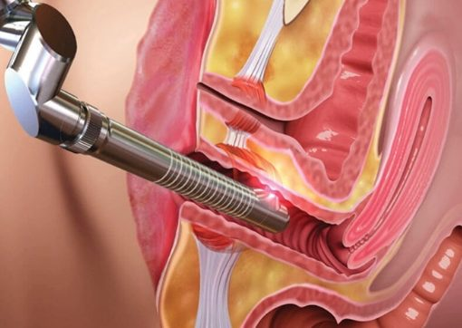 Vaginal Tightening